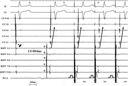 Representative electrograms illustrating the single case of unidirectional LA–PV block (same patient as Figure 4). The first beat shows entry block. The second beat reveals a PV automaticity beat (*) with PV–LA exit conduction after a LA–PV coupling interval of 894 ms. The third beat shows exit pacing from the mapping catheter within the encircled region which results in clear capture of the PV myocardial sleeves and 1 : 1 exit conduction towards the LA with the same activation pattern on the CS as the one observed during exit conduction from the PV automaticity. CS, coronary sinus; RSPV, right superior pulmonary vein; M, mapping catheter; LA, left atrium; PV, pulmonary vein.