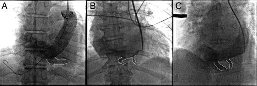 (A–C) Injection of contrast into the dilated CS showing branches of the epicardial venous system (outlined).