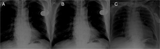 (A–C) Post-implant chest X-ray of Cases 1–3, showing position of the pacing leads.