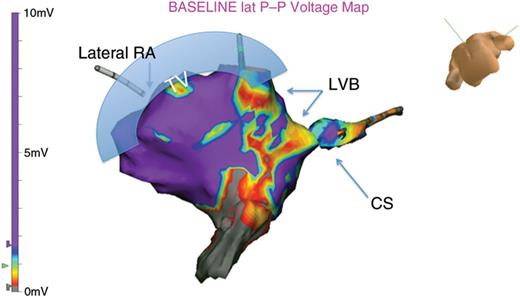 The anatomic relationship is displayed. In a caudel veiw, the tricuspid annulous is observed at the superior margin to the left of the image. The CS OS is observed to the right. The VGM shows high-voltage regions as purple, with LVBs seen as red and yellow. These LVBs are typically oberserved bridging high-voltage regions.