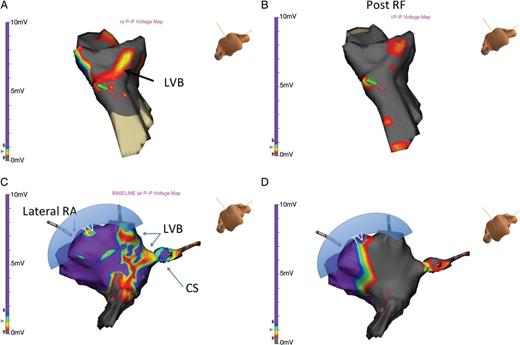 (A) A LVB is identified across in the lateral atrium to the CS region. This LVB outlines the path through the CTI and is perpendicular to the tricuspid annulus. (B) Following ablation, marked changes in voltage measurements are observed. No LVB is seen within the CTI, and BDB is achieved. (C) In this patient, the critical link is seen as a LVB that is parallel to the typical CTI associated LVB demonstrated in 2A. (D) Following ablation, no further voltage connection remains, confirming complete block along the CTI. BDB was observed.