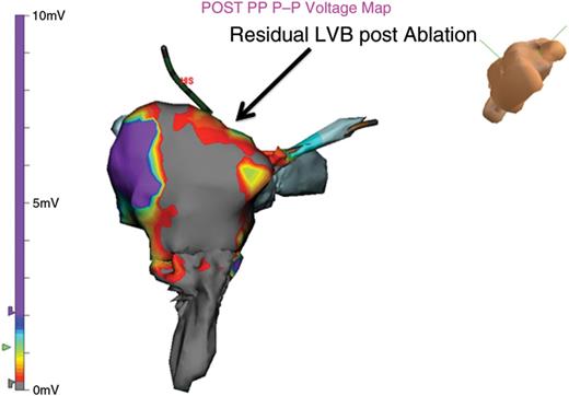 A residual LVB is found immediately following ablation. BDB is initially observed, despite the presence of a residual CTI LVB. Repeat pacing 10 min later, demonstrated recurrent CTI conduction. Permanent BDB required ablation of the residual LVB.