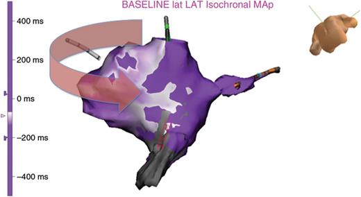 A propagation map is made during AFL, demonstrating penetration from the high-voltage region into the LVB connection. The corresponding VGM is displayed.