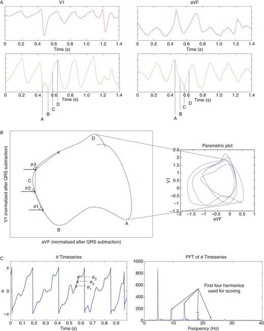 Electrocardiogram PL Method. (A) Electrocardiogram in orthogonal ECG leads V1 and aVF (lead I is also used). QRS subtracted ECG leads emphasize atrial activation. (B) Electrocardiogram spatial loop displayed from mutiple loops over AF cycles (right panel). Phase angles θ are calculated between times t, t + 1 for all time points t. (C) Timeseries of phase angle θ, showing periodicity that is highlighted in spectral plot. Electrocardiogram PL index is calculated from the area of the harmonics.