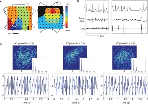 High ECG PL in persistent AF caused by two stable sources. (A) FIRM map (contact electrograms) shows RA rotor and LA focal source in AF; (B) ECG at baseline AF and during FIRM ablation, showing hyperacute termination of AF to sinus rhythm (5 min) with AF non-inducibility, before any other ablation. The RA rotor was primary. (C) Repeatable ECG spatial loops with periodic ECG phase θ timeseries and clearly delineated spectral harmonics. The maximum PL = 0.36 in YZ, or aVF/V1 (three-plane mean 0.25).