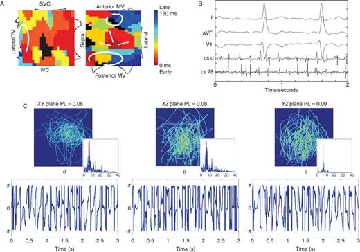 Low ECG PL in persistent AF caused by four stable sources, in which FIRM at three sources (per protocol) did not terminate AF. (A) FIRM map (contact electrograms) shows three rotors and one focal source. (B) Baseline AF. (C) Poorly reproducible ECG loops with aperiodic ECG phase θ timeseries and broadband spectra. Maximum PL = 0.086 in plane YZ (aVF/V1); three-plane mean = 0.083.
