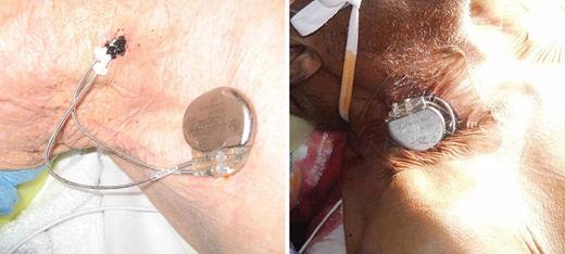 The temporary permanent pacemaker system securely taped to the patient's neck with a Tegaderm™ dressing.