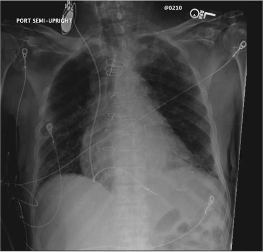 Chest X-ray after an implantation of the temporary permanent pacemaker system.