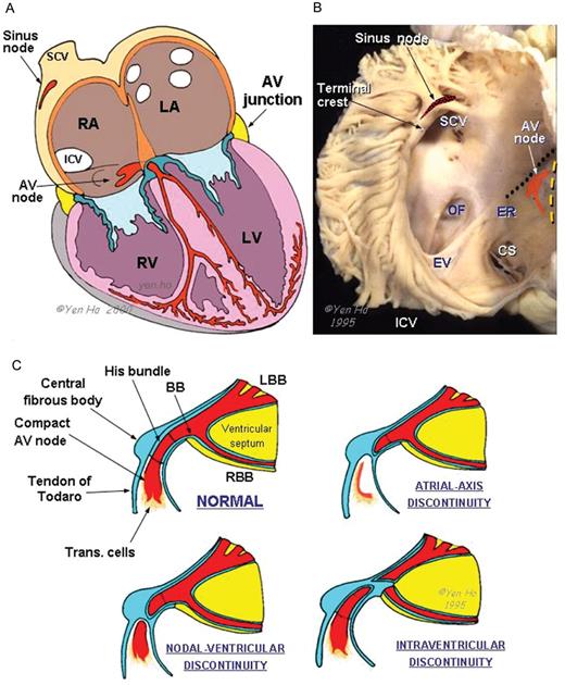 (A) Diagram of the cardiac conduction system. (B) The right atrium is opened to show the triangle of Koch delimited by the hinge line of the tricuspid valve anteriorly (broken line), the tendon of Todaro (dotted line) posteriorly, and the coronary sinus (CS) inferiorly. The sinus node lies in the terminal crest at its antero-lateral junction with the superior caval vein (SCV). (C) These four panels depict the normal components of the atrioventricular conduction system and the variants of interruption that are the anatomic substrates of congenital heart block. AV, atrioventricular; BB, branching bundle; LBB, left bundle branch; ER, Eustachian ridge; EV, Eustachian valve; ICV, inferior caval vein; LA, left atrium; LV, left ventricle; RA, right atrium; RV, right ventricle; Trans., transitional.