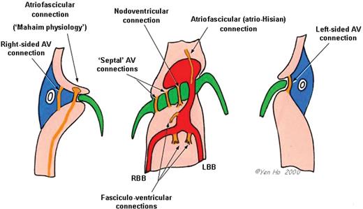 Diagram of the AV junctions depicting various types of accessory connections. AV, atrioventricular; LBB, left bundle branch; RBB, right bundle branch.