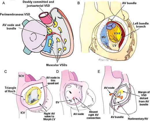 (A) Diagram showing the septal aspect of the right atrium and ventricle. The types of VSD (yellow shapes) are shown in relation to the course of the AV conduction tissues. The fibrous tissue (green) at the postero-inferior margin of the perimebranous VSD abuts the AV conduction bundle. (B) This diagram shows usual atrial arrangement with discordant AV connections with the morphologically LV opened. The AV conduction bundle passes antero-superior to the LV outlet and descends along the anterior margin of VSD. (C) The AV node is abnormally located. (D) The AV node is located in the muscular floor of the right atrium in hearts with ‘tricuspid atresia’ where there is absence of the right AV connection. (E) When viewed from the aspect of the rudimentary RV, the AV conduction bundle passes along the margin of the ventricular septal defect (VSD) that is nearest to the acute cardiac margin. AV, atrioventricular; VSD, ventricular septal defect; RV, right ventricle; LV, left ventricle; SCV, superior caval vein; ICV, inferior caval vein; MV, mitral valve.