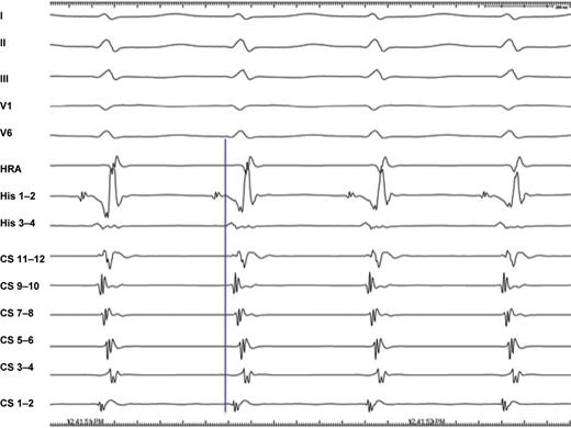 Typical slow–fast AVNRT. Earliest retrograde atrial activation is recorded either at proximal His or distal CS (CS 1–2) and proximal His (His 3–4). I–V6, 12-lead ECG leads; HRA, high right atrium; His, His bundle electrogram; CS, coronary sinus.