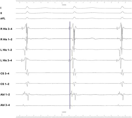 Typical slow–fast AVNRT. Simultaneous mapping of the right septum (R His), left septum (L His), and the anatomic area of the slow pathway is undertaken. Earliest retrograde atrial activation is recorded on the left septum. I–V6, 12-lead ECG leads; HRA, high right atrium; His, His bundle electrogram; CS, coronary sinus; Abl, ablation electrode at the anatomical area of the slow pathway.