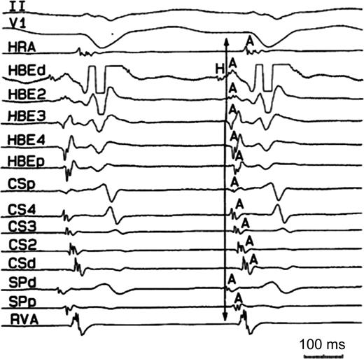Typical AVNRT. Note multiple retrograde atrial breakthroughs as depicted by simultaneous earliest retrograde atrial activation recorded at various sites of the His bundle electrode and the anatomic area of the slow pathway. I–V6, 12-lead ECG leads; HRA, high right atrium; His, His bundle electrogram; CS, coronary sinus; SP, slow pathway; RVA, right ventricular apex.