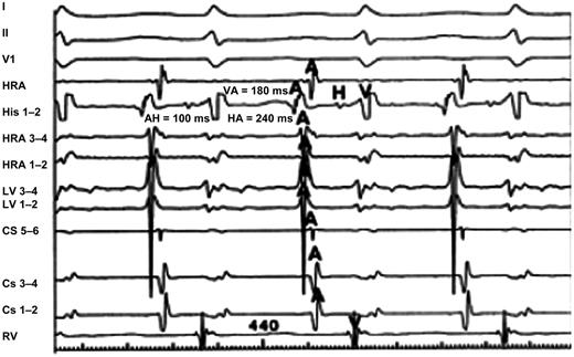 Atypical AVNRT. The form is conventionally fast–slow (AH < HA, HA > 70 ms, AH < 200 ms), and earliest retrograde atrial activation recorded at the His bundle electrode. I–V6, 12-lead ECG leads; HRA, high right atrium; His, His bundle electrogram; CS, coronary sinus; LV, electrode at the left side of the septum; RV, right ventricle.