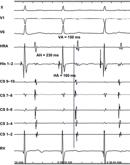 Atypical AVNRT. The form is conventionally slow – slow (AH > HA, HA > 70 ms, AH > 200 ms) and earliest retrograde atrial activation is recorded at the His bundle.