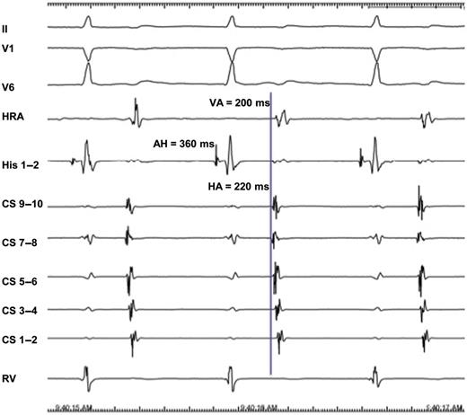 Atypical AVNRT. The form is slow–slow (AH > HA, HA > 70ms, AH > 200ms), and earliest atrial retrograde activation is recorded simultaneously at His bundle and distal CS (CS 7–8).