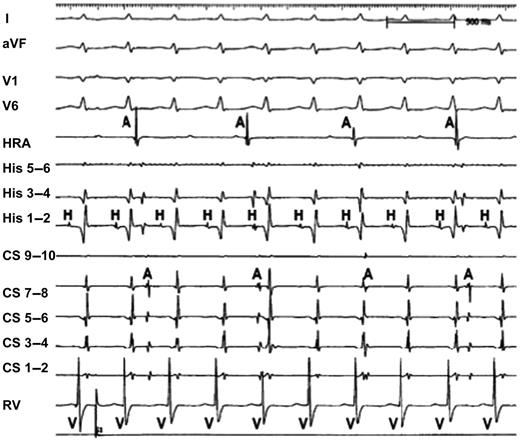 Atrioventricular dissociation during AVNRT. Atrial activation is not related to His bundle electrograms, and the last A–A interval is not the same with the previous ones. This suggests retrograde block with variable conduction.