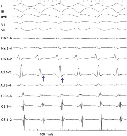 Typical AVNRT conducted with LBBB aberration and with inability to record His bundle electrograms. Retrograde atrial electrograms are indicated by arrows.