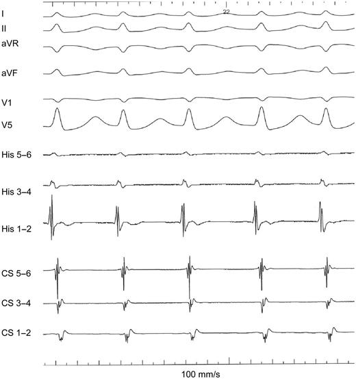 Typical AVNRT with simultaneous occurrence of antegrade ventricular and retrograde atrial activation and inability to record a stable His electrogram.