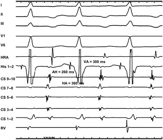 Atypical AVNRT. The form is fast–slow according to the AH < HA definition, but slow–slow according to the AH > 200 ms criterion.