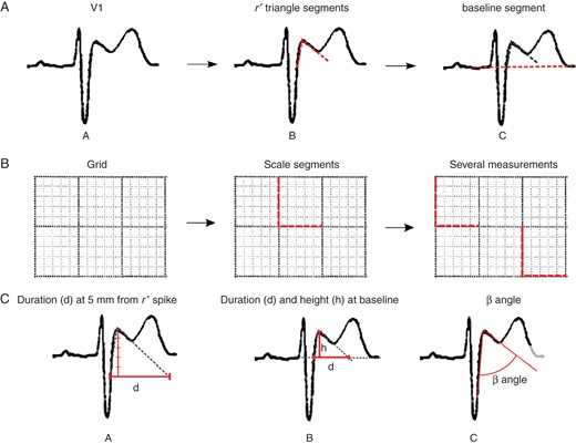 (A) Segment location performed by the observers. (A) Original signal. (B) Segment location at upslope and downslope of r′-wave. (C) Segment location at the isoelectric line. (B) Segment location for scale measurement from the original grid—vertical and horizontal segment locations following 5 mm2 grid. (C) Measurements extracted from located segments by the analysts—(A) the duration of the base of the triangle at 0.5 mV from r′-wave high take-off, (B) Height and duration of the triangle at the isoelectric line, (C) angle from S wave upslope and r′ downslope (β angle).