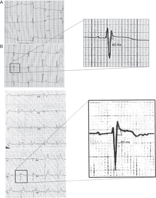 Two examples of healthy athletes ECG. (A) Healthy athlete with ST-T elevation and r′-wave but with a base of the triangle at 0.5 mV measuring 40 ms (1 mm). (B) Electrocardiogram of a healthy athlete with similar ST-T morphology and the base of triangle measuring 80 ms (2 mm).