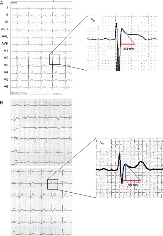 Two examples of Type-2 Brugada ECG pattern. (A) Type-2 Brugada pattern with the base of the triangle at 0.5 mV, measuring 184 ms (4.6 mm). (B) Type-2 Brugada pattern with base of the triangle at 0.5 mV measuring 188 ms (4.7 mm).