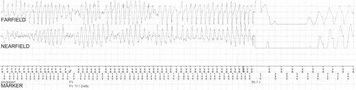 Episode of VF terminated by shock therapy at 4 weeks gestation in Patient #9. This episode of VA occurred in a woman who was 4 weeks pregnant and not complying with β-blocker treatment during a domestic dispute (i.e. in a hyperadrenergic setting). The onset of the VF (not shown) was preceded by a sinus node tachycardia. A short-coupling premature ventricular complex (with coupling interval 160 ms) triggered VF, which was terminated by a shock of 30 J. The total duration of the episode was 10 s. CD, charge delivered; CE, charge ended; FD, fibrillation detected; FS, fibrillation sense; FV, ventricular fibrillation; VS, ventricular sense.