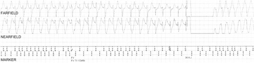 Episode of T-wave oversensing that triggered an inappropriate shock in Patient #9. This episode occurred a few seconds after the appropriate shock shown in Figure 1. Intermittent episodes of oversensing of spontaneous T-waves occurred leading to double counting during sinus rhythm. As a result, an inappropriate ICD shock (30 J) was delivered. CD, charge delivered; CE, charge ended; FD, fibrillation detected; FS, fibrillation sense; FV, ventricular fibrillation; VS, ventricular sense.