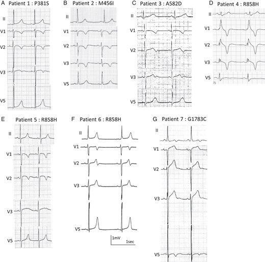 Electrocardiograms of CACNA1C mutation carriers. (A) An 8-year-old girl, p. P381S; (B) a 12-year-old girl, p. M456I; (C) a 12-year-old girl, p. A582D; (D) a 54-year-old woman, p.R858H; (E) a 7-year-old boy, p. R858H; (F) a 15-year-old boy, p.R858H; (G) a 58-year-old woman, p.G1783C.