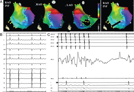 (A) Electroanatomic mapping of macroreentrant right atrial tachycardia. The activation map shows an atriotomy-dependent reentrant circuit. Pale-blue tags indicate the atriotomy site at the lateral wall. The colour code shows the wavefront propagation around the atriotomy site. The red colour indicates the earliest while the purple one the latest wavefront activation. The red bar indicates the ‘early meets late’ automatic interpolation. The black line on RAO INF view is the linear ablation extending from the inferior part of the atriotomy to the inferior vena cava (IVC) with the aim of eliminating the inferior isthmus of conduction. RAO INF, right anterior oblique view from an inferior aspect; RAO, right anterior oblique view; LAO, left anterior oblique view. (B) Surface ECG of the clinical arrhythmia. (C) Interruption of the tachycardia with the restoration of sinus rhythm during linear ablation of the inferior isthmus of conduction. CS 1,2—CS 9,10: bipolar recordings from coronary sinus catheter; ABL d and p: bipolar recordings from distal tip and proximal pair of electrodes of the ablation catheter; I-II-aVL-V1: Surface ECG recordings.