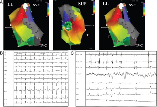 (A) Electroanatomic mapping of macroreentrant right atrial tachycardia. The activation map shows a reentrant circuit around the superior vena cava (SVC). The atriotomy has been performed longitudinally suturing directly the atrial septal defect and extending down to the IVC through the posterior wall. This atriotomy/scar is crucial in creating the isthmus critical for the occurrence of the arrhythmia. The color code shows a wavefront propagation around the atriotomy site. The red bar indicates the ‘early meets late’ automatic interpolation. Gray area indicates scar tissue. The black line indicates the site of the linear ablation extending from the superior part of the atriotomy to the SVC with the aim of eliminating the critical isthmus of conduction. LL, left lateral view; SUP, superior view; T, tricuspid ring. (B) Surface ECG of the clinical arrhythmia. (C) Tachycardia interruption during linear ablation of the critical isthmus of conduction. CS 1-2, 5-6: bipolar recordings from coronary sinus catheter; ABL d: bipolar recordings from distal tip of the ablation catheter; I–II–III–V1: Surface ECG recordings.