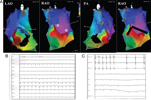 (A) Electroanatomic mapping of macroreentrant right atrial tachycardia. The activation map shows a figure of ‘8’ reentrant circuit around two pivot points (*) in the right lateral wall. The atriotomy has been performed longitudinally in superior/posterior intercaval line and lateral right atrial wall. It presents some conduction gaps creating the electroanatomic substrate for the figure of ‘8’ circuit. The colour code shows the wavefront propagation during tachycardia. The red colour indicates the earliest while the purple one the latest wavefront activation. The red bar indicates the ‘early meets late’ automatic interpolation. Gray area indicates scar tissue. The black line indicates the site of the linear ablation extending from the pivot points to the lateral tricuspid ring and to the IVC with the aim of eliminating the isthmus of conduction. LAO, left anterior oblique view; RAO, right anterior oblique view; PA: postero-anterior oblique view. (B) Surface ECG of the clinical arrhythmia. (C) Tachycardia interruption during linear ablation extending from the pivot points to the lateral tricuspid ring and to the IVC with the aim of eliminating the isthmus of conduction. CS 3-4, 7-8: bipolar recordings from coronary sinus catheter; I–II–III–V1: Surface ECG recordings.