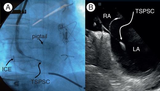 Images during the procedure. (A) Right anterior oblique view showing the LA Crosse™/Agilis™ catheter system directed towards the septum with the LA cross™ system extended by 20 mm beyond the distal tip of the Agilis™ sheath. (B) Intracardiac echocardiography (ICE) images showing the LA Cross™ system across the septum with the distal tip in the LA. ICE, intracardiac echocardiography; RA, right atrium; LA, left atrium.