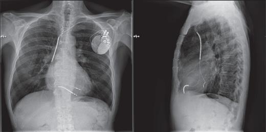 Anteroposterior and lateral RX images showing the final position of the left endocardial ventricular lead and the right ventricular lead.