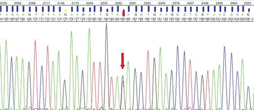 Electropherogram. The mutation was a C -> T transition at exon 11 in the DSP gene leading to a premature stop codon.