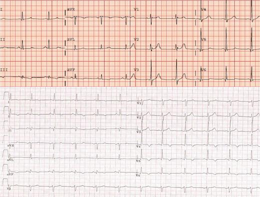 ECG from a LVNC patient (top) (C.III.5) and a DCM patient (bottom) (A.IV.7) T wave inversion in inferolateral leads was the most common abnormality in ECG.