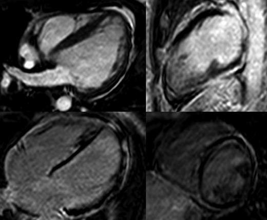 Magnetic resonance of a LVNC (C.III.5) (top) and DCM patient (A.IV.7)(bottom).