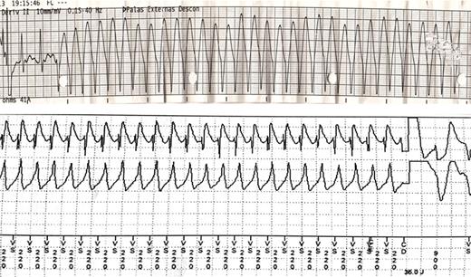 Sustained ventricular tachycardia (S-VT) recorded at the emergency department during resuscitation manoeuvres (top). Implantable cardioverter-defibrilator recordings showing S-VT and the beginning of another S-VT of a different morphology after shock delivery (bottom). Four shocks were necessary to restore sinus rhythm (C.III.5).
