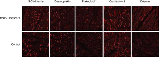 Immunohistochemistry from an EMB. No difference in the distribution of desmoplakin present in DSP c.1339C>T compared with the control. Plakoglobin, connexin-43 and desmin also show an identical distribution.