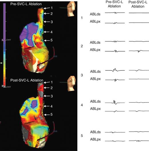 Right atrial voltage maps before and after SVC-L ablation (left lateral views) and electrogram changes along the SVC-L.