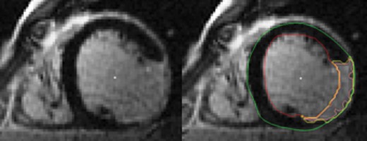 Scar area assessment by LGE-CMR in short-axis orientation. On the right panel, yellow contour indicates scar area, green contour the epicardial border, and red contour the endocardial border. Endocardial and epicardial LV borders as scar tissue were semi-automatically delineated in each LV short-axis slice. Three aspects of scar were quantified: the percent scar, the scar mass, and the transmural scar extent. The percent scar was calculated by summing the absolute amount of hyperenhanced tissue for all LV short-axis slices divided by the total amount of LV tissue. The scar mass was obtained by multiplying the percent scar by LV mass. For the transmural scar extent, scar presence ≥75% was defined as transmural and the number of LV segment was expressed in the standard AHA 17-segment model. LGE-CMR, late gadolinium enhancement cardiac magnetic resonance; LV, left ventricular.