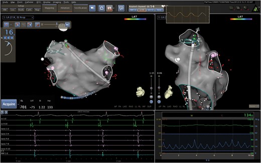CARTO® 3 system screen showing a reconstruction of the LA in posteroanterior view (top left) and left lateral view (top right) with a decapolar circular mapping catheter and an ablation catheter placed at the ostium of the left superior PV. The dashboard on the left-hand side shows the value of CF (16 g), while the arrow on the catheter icon shows the CF direction. The real-time graph of the CF vs. time is also shown (blue line in the bottom right pane). Surface electrocardiogram and intracavitary electrograms from the coronary sinus catheter and circular mapping catheter before ablation are also shown (bottom left).