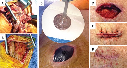 Surgical technique for NPWT. (A) Excision of the infected capsule. (B) The pocket after complete capsulectomy and debridement. (C) Application of NPWT. The wound has been packed with a sponge and covered with an occlusive dressing with a hole. The suction tube is attached to an adhesive support. See text for details. (D) The wound after completion of NPWT. (E) Closure of the wound with prolene sutures. (F) The healed wound one month after discontinuation of NPWT.