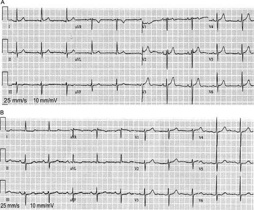 (A and B) ECG tracings from two of the study patients: a patient with absent LAMC (A) and a patient with intact LAMC (B). Patients with absent LAMC had more frequently small P-wave amplitude at V1–4, a positive-only deflection at V1, and a negative-only deflection at aVL compared with patients with intact LAMC.