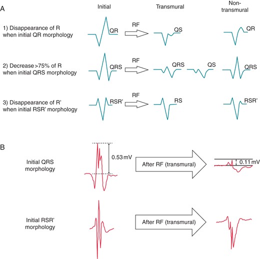 (A) Distal bipolar EGM criteria of TL after RF, depending on initial morphology. (B) Examples of recorded EGMs before and after RF, with different initial morphologies, displayed at 200 mm/s.