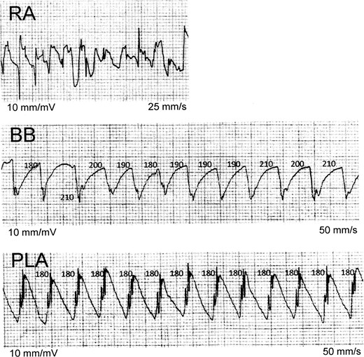 Sequential recordings of bipolar AEGs during AF: this figure, recorded from Patient 1, illustrates sequential recordings of bipolar AEGs during AF. Posterior LA AEGs demonstrate a regular CL (180 ms) with constant morphology, the BB AEGs demonstrate a slightly irregular CL with constant morphology, and the RA AEGs demonstrate an irregular CL with variable morphology. Bachmann's bundle and PLA electrograms demonstrate a prominent current of injury. Note that the RA AEGs demonstrate how difficult it can be to determine precise CL intervals when CLs are grossly irregular and have varying morphology. AEGs, atrial electrograms; AF, atrial fibrillation; BB, Bachmann's bundle; CL, cycle length; PLA, posterior left atrium; RA, right atrium. All numbers are in milliseconds.