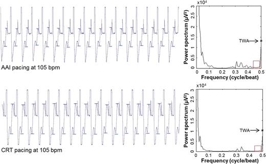 Example of device-recorded EGMs and corresponding spectral TWA measurements at baseline pacing tests. Top: EGM and 102 µV TWA during AAI pacing at 105 b.p.m. Bottom: EGM and 91 µV TWA during CRT pacing at 105 b.p.m. Visible TWA (peak-to-peak T-wave amplitude between two small bars) presents in EGM recording during pacing test.