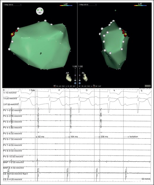 Right superior pulmonary vein gap ablation during a repeat RFC procedure after CB2. In the 3D map, the yellow dot represents the site of PV re-isolation and the red dots represent RFC ablation sites. The intracardiac tracings show the progressive delay and entry block developed during spot ablation.
